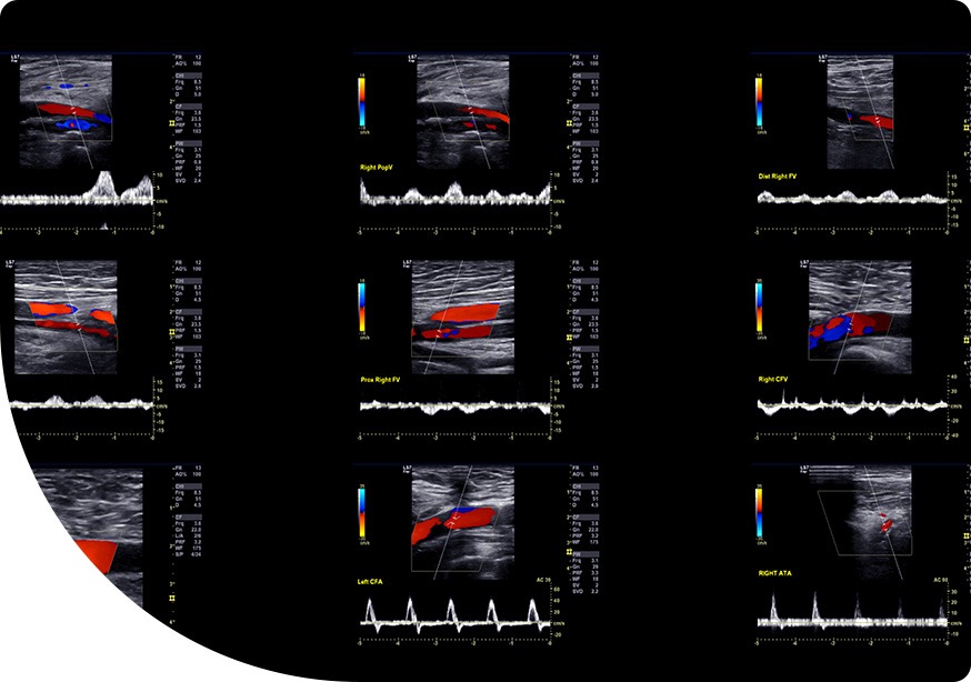 Vascular Ultrasound | Saddletown Radiology | NE Calgary | Radiology Clinic