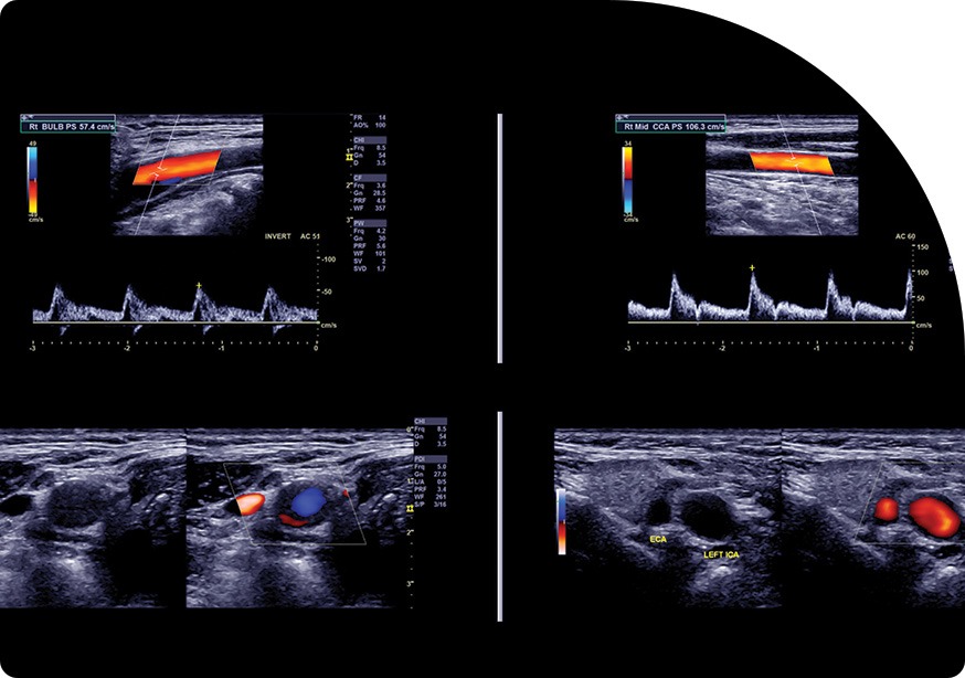Arterial Ultrasound | Saddletown Radiology | NE Calgary | Radiology Clinic